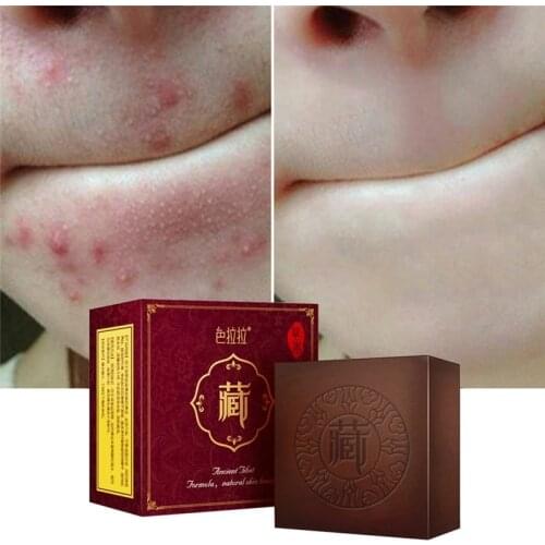 Wash Face Soap Natural Non-irritating Oil Control Removal Blackhead Facial Anti Mites Tibetan Medicine Soap Cleansing Soap