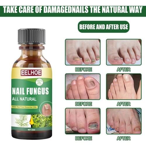 30ML Fungal Nail Repair Essences Care Treatments Foot Nail Fungus Remove Anti-sensitive Paronychia Onychomycosis Nail Crack Care