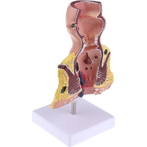 Pathological Model of Hemorrhoids Anorectal Teaching Anatomy Model - Anorectal Pathology Model