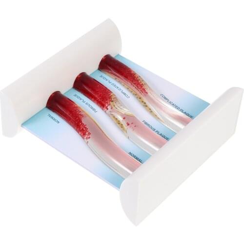 LDL Blood Vessel Model Human Blood Vessel Model Anatomical Model Teaching Tool