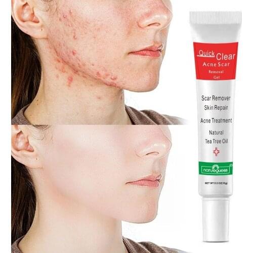 Acne Treatment Face Cream Scar Blackhead Remover Repair Gel Oil Control Shrink Pores Whitening Skin Care Cosmetics