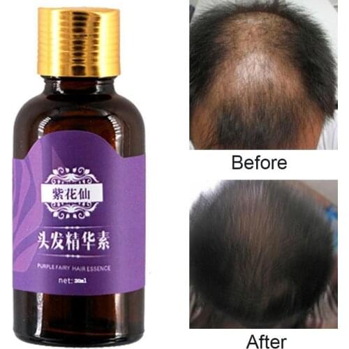 20/30ml Hair Growth Serums Anti Loss Moisturizing Scalp Treatment Essential Oil