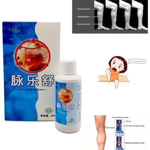 Vasculitis spray Varicose veins treatment spray on leg acid bilges itching earthworm lumps bad leg cure natural solution