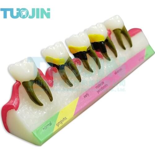 Dental Periodontitis Evolution Model Tooth Decay And Caries Evolution Model Tooth Teaching Demonstration Demonstration
