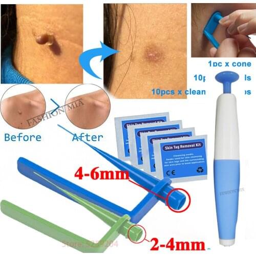 Auto Band Skin tag remover Kits Face Skin Care Beauty Tools Wart Remove Acne Pimple Blemish Treatments With 10pcs Rubber bands