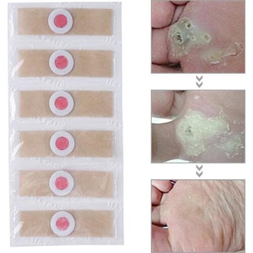 Toe Foot Corn Detox Patches Calluses Thorn Sticker Plaster Corns Remover Kit Little Pain Effective Disinfectant Stimulation