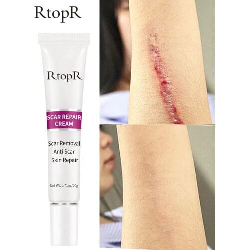 RtopR Acne Scar Stretch Marks Remover Cream Skin Repair Face Cream Acne Spots Acne Treatment Blackhead Whitening Cream Skin Care