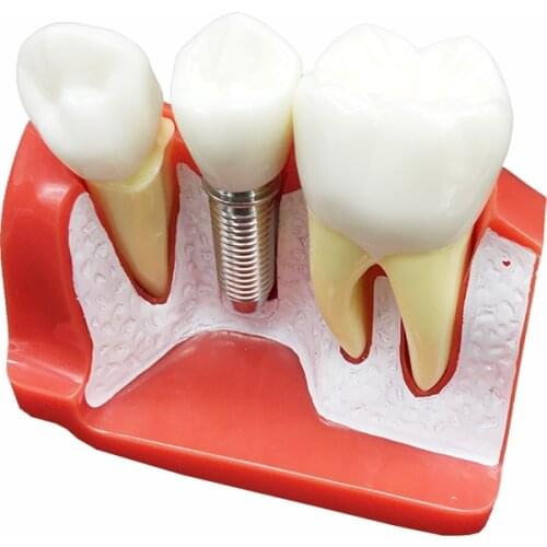 Teeth Model Dentist Studying Dentistry Product Demonstration Model Implant Analysis Model