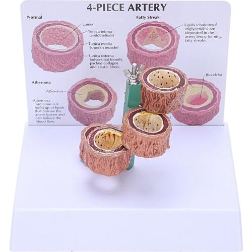 Atherosclerosis Thrombosis Model Vascular Disease Demonstration Heart Vascular Pathology Model