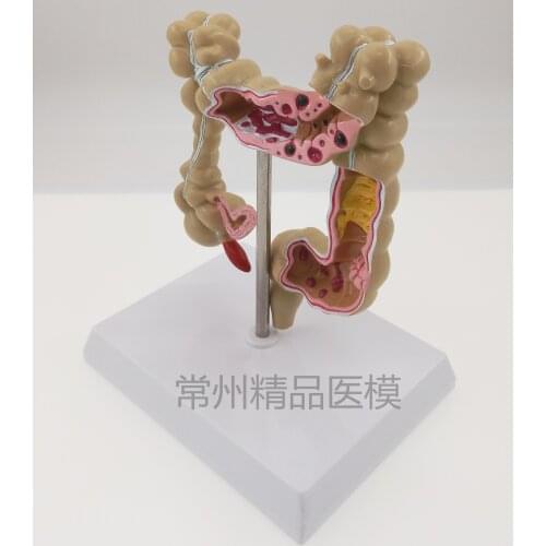 Colon pathological model Colorectal lesions intestinal Specimen large intestine anatomy teaching model
