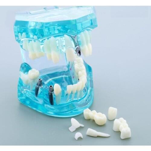Dental Implant and Restoration Model with Nerve M2001Dental Mariland Bridge Study Model Crystal Dental Tooth Model