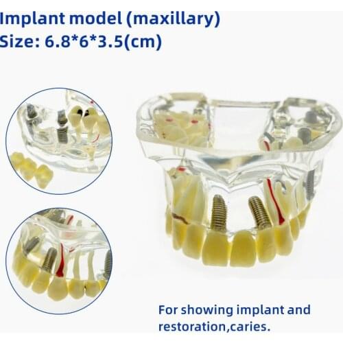 Dental Implant Upper Jaw Model With Bridge & Caries Dental Study Teach Teeth Model