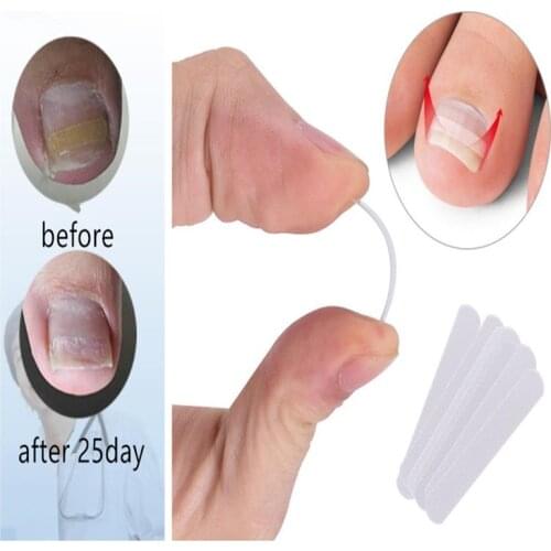 10pcs Ingrown Toenail Correction Tool Ingrown Toe Nail Treatment Elastic Patch Sticker Straightening Clip Brace Pedicure Tool