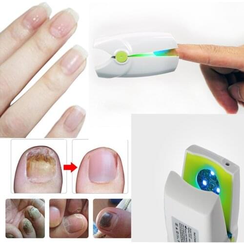 Rechargeable Nail Fungus Laser Treatment Device for Onychomycosis Cure. This Instrument is for Home use and Treats Nail Fungus