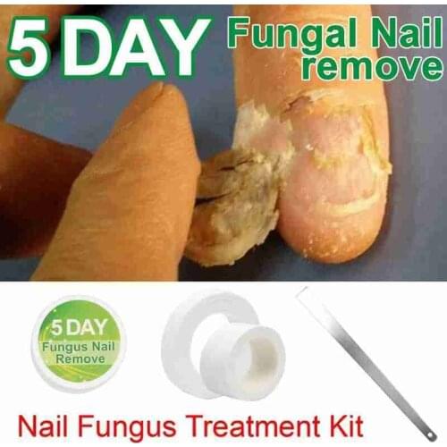 Chinese Medicine Herbs Nail Toenail Fungus Treatment Cream Anti Fungal Infection Onychomycosis Nail Removal Essence for manicure