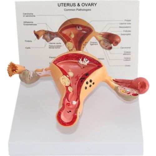 1:1 Pathological Uterus and Ovary Anatomical Model In Trauma Anatomy Skeleton Dental Anatomical Shadow Medical Training Manikins