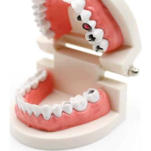 Pro Dental Study Teaching White Teeth Model Caries Tooth Care Oral Education Dentist Equipment Oral Care Tool