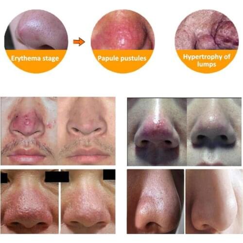 Herbal Anti Nose Mites Remove Acne Rosacea Cream Red Acne Treatment Bleaching Pores Nose Remover Blackhead Shrink Face Oint W3I9