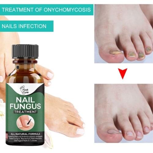 30ML Fungal Nail Repair Essences Care Treatments Foot Nail Fungus Remove Anti-sensitive Paronychia Onychomycosis Nail Crack Care