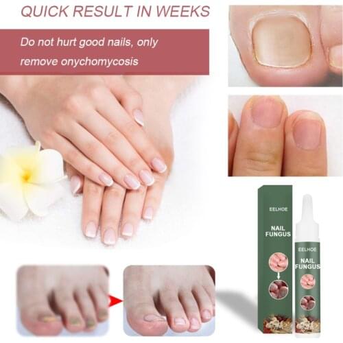 Eelhoe 20ml Nail Treatments Nail Antifungal Repair Liquid Hand and Foot Onychomycosis Repir Fluid Foot Care Nail Art Manicure