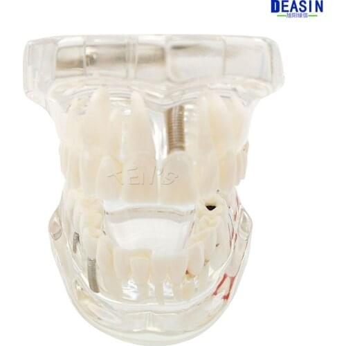 High Quality 2016 NEW Arrival Dental implant Demonstration Bracket Simulation Teeth Model teeth removable