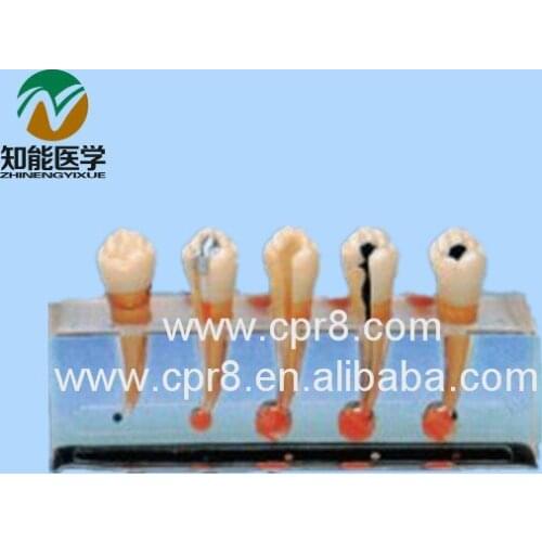 BIX-L1011 Clinical Dental Pulp Disease Model Dental Model MQ152