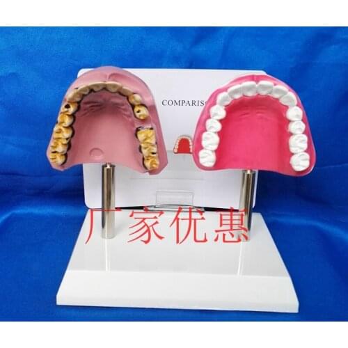 Nursing Tooth Model Medical Pathological Teeth Oral Care Model smoking and normal oral teeth Supplies