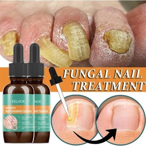 30ml Onychomycosis Toe Nourishing Brighten Hand Foot Skin Care Nail Repair Essence Serum Fungal Nail Treatment Remove