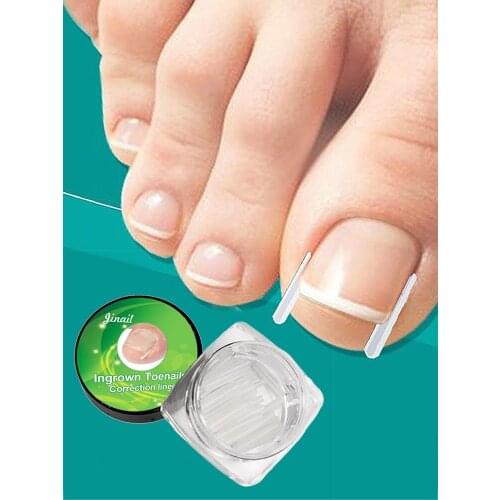 Pedicure 10pcs/set Ingrown Nail Pad Ortho Nail Filling Nail Groove Pad Ingrown Nail Corrector Ingrown Nail Artifact
