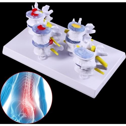 1 Set Human Lumbar Lesion Spine Statue Display Model Medical Teaching Learning Tool