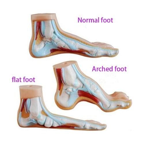 Human Foot Model Foot Muscles Flatfoot Talipes cavus Bow foot model Anatomical Anatomy Medical Science teaching model