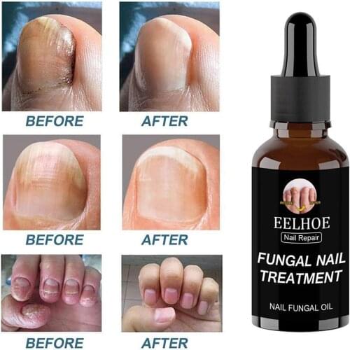 New Nail Repair Solution Toe Nail Treatment For Toe & Fungus Care Infections Nail Nail Anti-Fungal M4O1