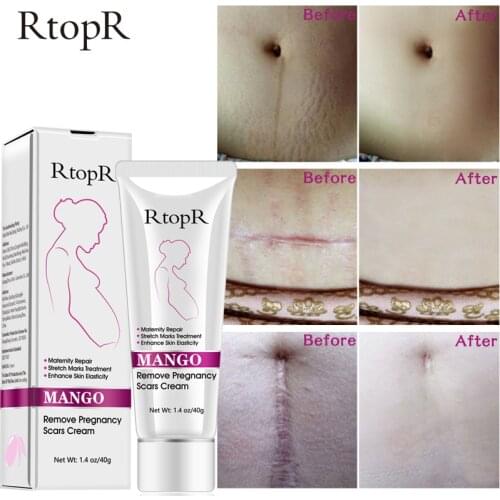 40G Remove Pregnancy Scars Skin Body Cream Postpartum Stretch Marks Repair Cream Anti-Aging Skin Winkles Firming Body Cream