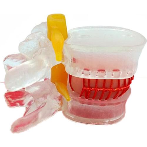 Spine Bone And Lumbar Intervertebral Disc Mold Vertebral Body Model Protrusion Compression Pathological Bone Teaching Aid