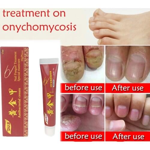 Chinese Medicine Plaster Nail Fungus Treatment Cream Onychomycosis Anti Fungal Nail Infection Fights Bacteria Naturally Ointment