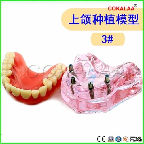 Good quality Maxillary planting model dental Upper jaw implant model dentures teeth model for dentists learning