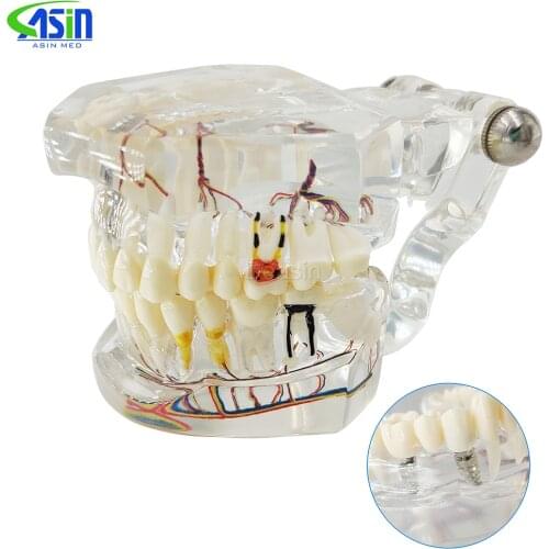 High quality dental teeth model Transparent pathological implant nerve model Repair model Teaching demonstration model