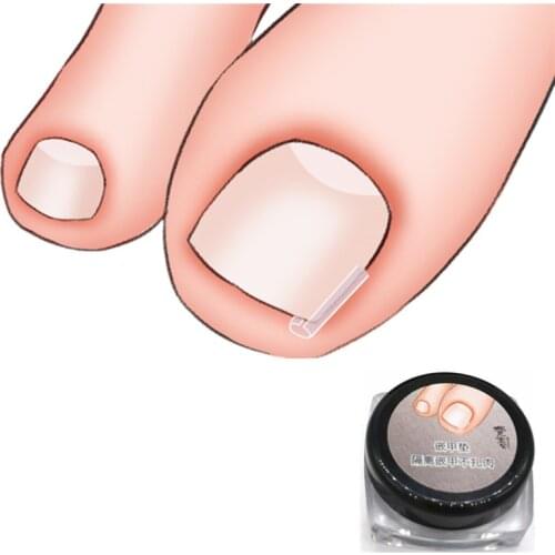 20-Piece Nail Pad Inlay Nail Infilled Pad Nail Groove Pad Onyxis Corrector Inlay Nail Toenail Straightening Sticker Nail Silk