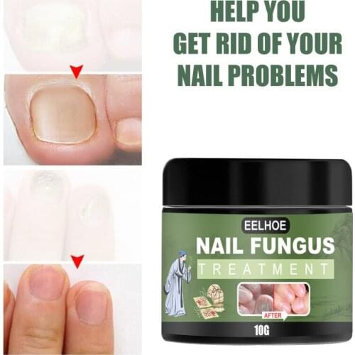 Anti Fungal Foot Cream Onychomycosis Antibacterial Treatment Cream Nail Repair Cream Paronychia Toe Fungus Gel Feet Care