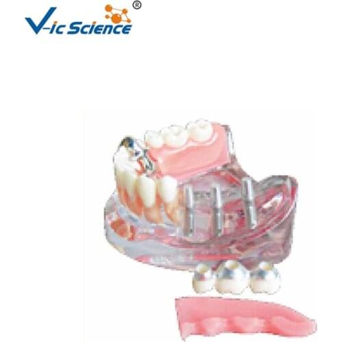 Implant Demonstration Explanation Model/Implant Demonstration Model/Implant Explanation Model