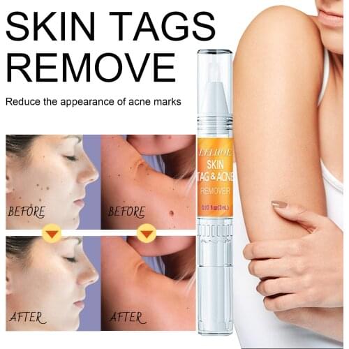 3ml Genital Wart Treatment Papillomas Removal Of Warts Liquid From Skin Tags Removing Against Moles Remover Anti Verruca Remedy