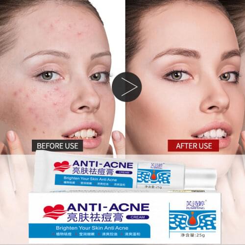 Acne Treatment Face Cream Effectively Remove Pimple Scar Anti Acne Oil Control Shrink Pores Repair Moisturizer Facial Skin Care