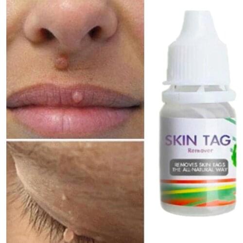 Skin Tag Remover Wart Treatment Papillomas Removal Liquid Against Moles Remover Anti Verruca Remedy Ointment 10Ml