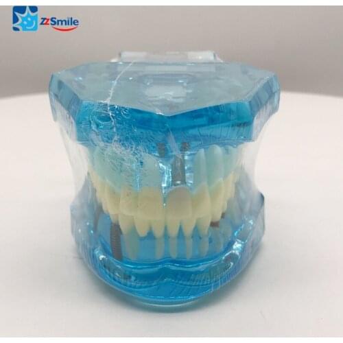 Dental Impant Model/M2001 Implant and restoratin model/Dental Teeth Study Model