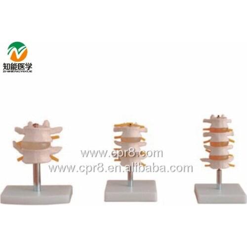 BIX-A1010 Normal Lumbar Set, Lumbar Vertebrae(2pcs,3pcs,4pcs) WBW388