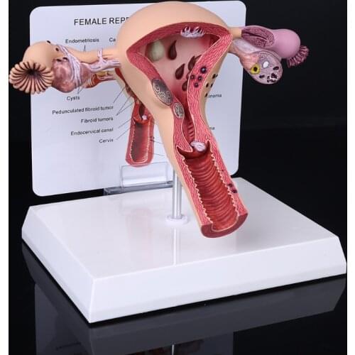 Human Female Uterus Ovary Disease Dissection Pathology Model Biology Teaching Aids Anatomy Lesion Uterus School Supplies