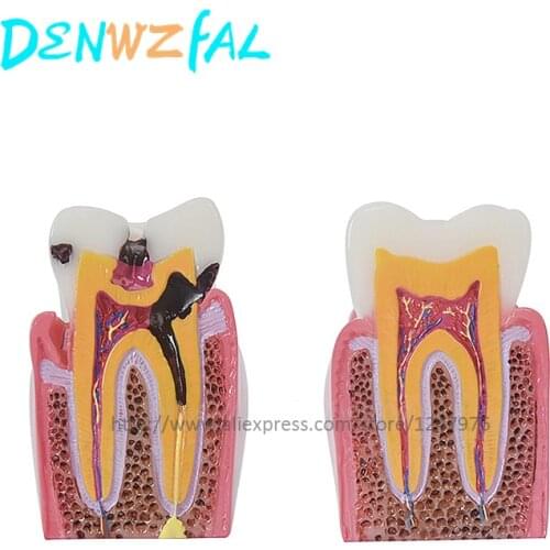 Six-fold dental caries contrast model dental decay demonstration model sectional model doctor-patient communication for teaching