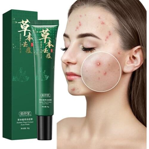 30ml Acne Cream for Face Back Anti-Acne Scar Remover Cream Pimple Spots Treatment Oil Control Whitening Anti-Aging Moisturizer