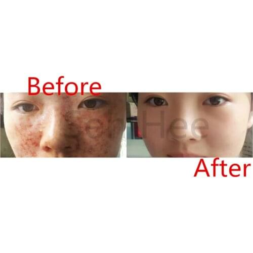 Retin-A Acne Anti Wrinkles Blemish Treatment 30g RETINOL VITAMIN A CREAM