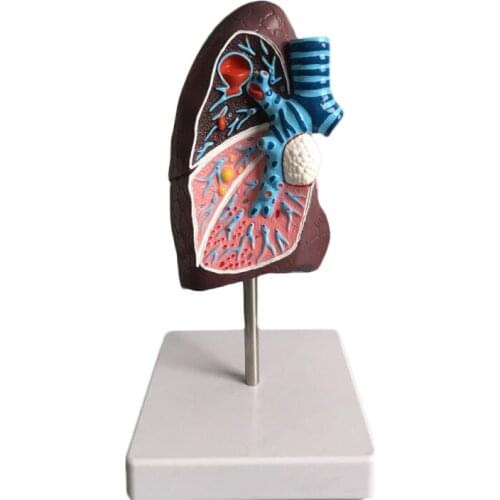 Medical human pathological lung model Internal medicine model Lung model Lung anatomy Respiratory system model